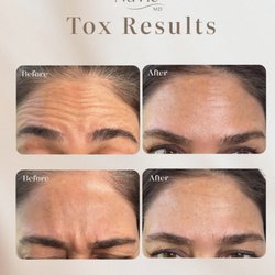 Letybo tox results after two weeks of injection