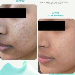 Secrets of Beauty Skin & Body - #advance skin tightening