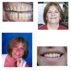 Anne B Filler, DMD, MAGD - Patient presented with denture that she had worn for over 20 years.  A new upper and lower esthetic denture was made with lig...