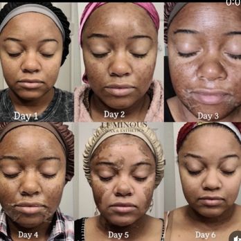 Luminous Wax And Esthetics - Chemical peel - Skin Care Near Me - Casselberry, Florida Luminous Wax And Esthetics - Chemical peel - Skin Care Near Me - Casselberry, Florida