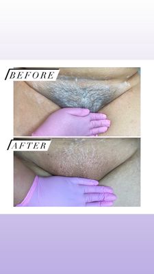 Brazilian Sugaring - Get ready for the beach! I offer a full Brazilian for just $60 Brazilian Sugaring - Get ready for the beach! I offer a full Brazilian for just $60