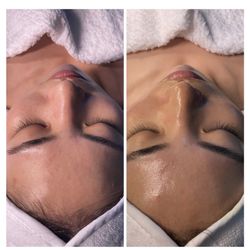 MoonGLO Aesthetics - Deluxe Hydrafacial