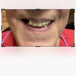 Advanced Dentistry South Florida in Delray Beach - Before