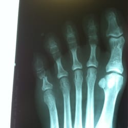 Feldman Stefan DPM Podtrst - My broken foot