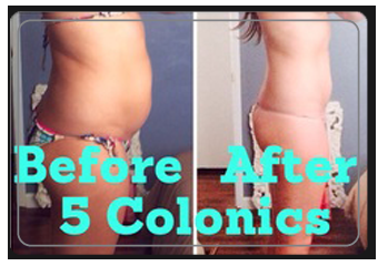 Colonic Cleansing - What people eat affects their body and mental health. If the intestines are unable to absorb crucial vitamins and minerals, your concentration can be lower. A poor diet also leads to lower energy levels. Colon hydrotherapy cleans out the body and allows the right nutrients to be absorbed. This will benefit the body, which may result in better clarity and more energy.
When waste products remain in the body, constipation often occurs. This obviously impairs normal digestion. A colon cleanse clears out this waste and anything else affecting digestion. It also improves the peristalsis movement and muscle tone of the intestine. With these improvements, it moves waste easier. Colonic Cleansing - What people eat affects their body and mental health. If the intestines are unable to absorb crucial vitamins and minerals, your concentration can be lower. A poor diet also leads to lower energy levels. Colon hydrotherapy cleans out the body and allows the right nutrients to be absorbed. This will benefit the body, which may result in better clarity and more energy.
When waste products remain in the body, constipation often occurs. This obviously impairs normal digestion. A colon cleanse clears out this waste and anything else affecting digestion. It also improves the peristalsis movement and muscle tone of the intestine. With these improvements, it moves waste easier.