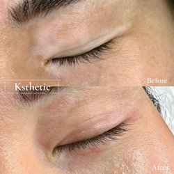 Ksthetic - Vitiligo Camouflage