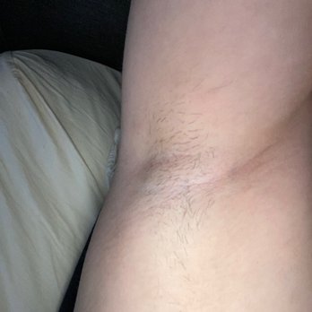LaserAway - My under arm still growing plenty of hair 12 treatments later - Medical Spas Near Me - Folsom, California LaserAway - My under arm still growing plenty of hair 12 treatments later - Medical Spas Near Me - Folsom, California