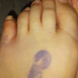 St Mary's Medical Center - Broken toes