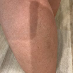 Deluxe Nails - Bruising on my other leg the day following the pedicure.