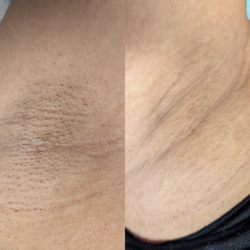 EyeLove Beauty - Underarm Detox Service -  Before & After