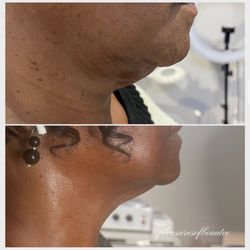 Pleasures Of Beautee - Fat dissolving injections in the chin.