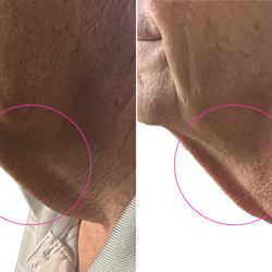 Beauty Freak - Cryo Neck & Chin Tighten - before-and-after