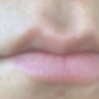 John Diaz, MD - Before - Cosmetic Surgeons Near Me - Beverly Hills, California John Diaz, MD - Before - Cosmetic Surgeons Near Me - Beverly Hills, California