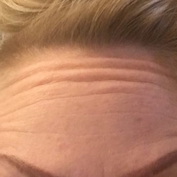 Body Beautiful Laser Medi-Spa - Botox was used instead of dysport like I asked for in my tzone and he only put it in the middle of my forehead looks really stupid! - Laser Hair Removal Near Me - Bridgewater, Pennsylvania Body Beautiful Laser Medi-Spa - Botox was used instead of dysport like I asked for in my tzone and he only put it in the middle of my forehead looks really stupid! - Laser Hair Removal Near Me - Bridgewater, Pennsylvania