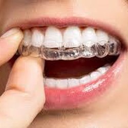 Kathy Jacobsen, DMD - Contemporary Dentistry - Clear aligners can straighten your smile fast. Call today for a consult to straighten your smile. 480-507-1807