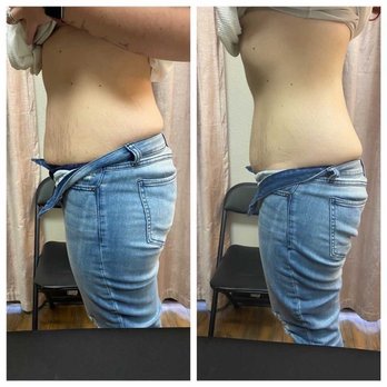 Bodies By Bobbi - First treatment results! - Body Contouring Near Me - Las Vegas, Nevada Bodies By Bobbi - First treatment results! - Body Contouring Near Me - Las Vegas, Nevada