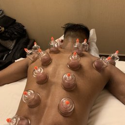 Cupping therapy Cupping therapy