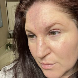 VIP Weight Solutions & Med Spa - 20 units Botox + 1 cc Juvederm on Thur, Jan 19. Skin is dry, peeling & bruised on forehead, nose & inner eyelid. Photos from 1/19 & 1/22.