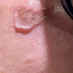 Miami Aesthetic Institute - This is the after photo - consistency of the skin is completely different. My pores are completely different