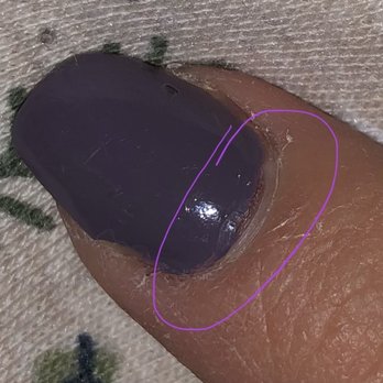 V Nails - Blood bruise under nail - Nail Salons Near Me - Lexington, Virginia V Nails - Blood bruise under nail - Nail Salons Near Me - Lexington, Virginia