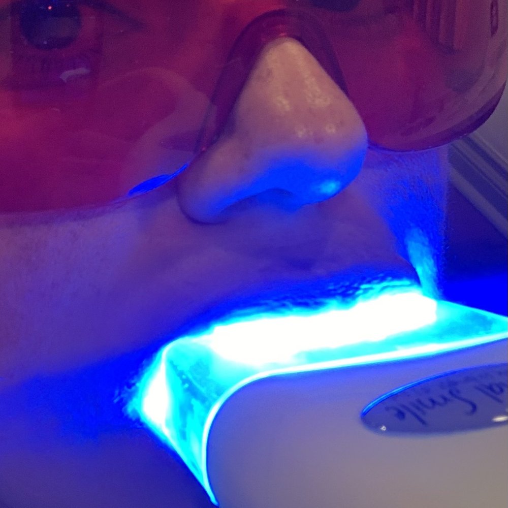 Teeth whitening process- not long at all. Teeth whitening process- not long at all.