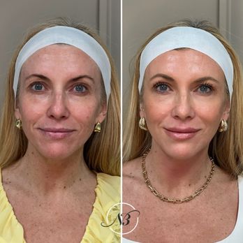 NuBella Med Spa - Before and After - Medical Spas Near Me - Irvine, California NuBella Med Spa - Before and After - Medical Spas Near Me - Irvine, California
