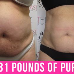 Fast Fit Body Sculpting - Fast Fit Body Sculpting Fat Weight Loss Review Before and After Skin Tightening