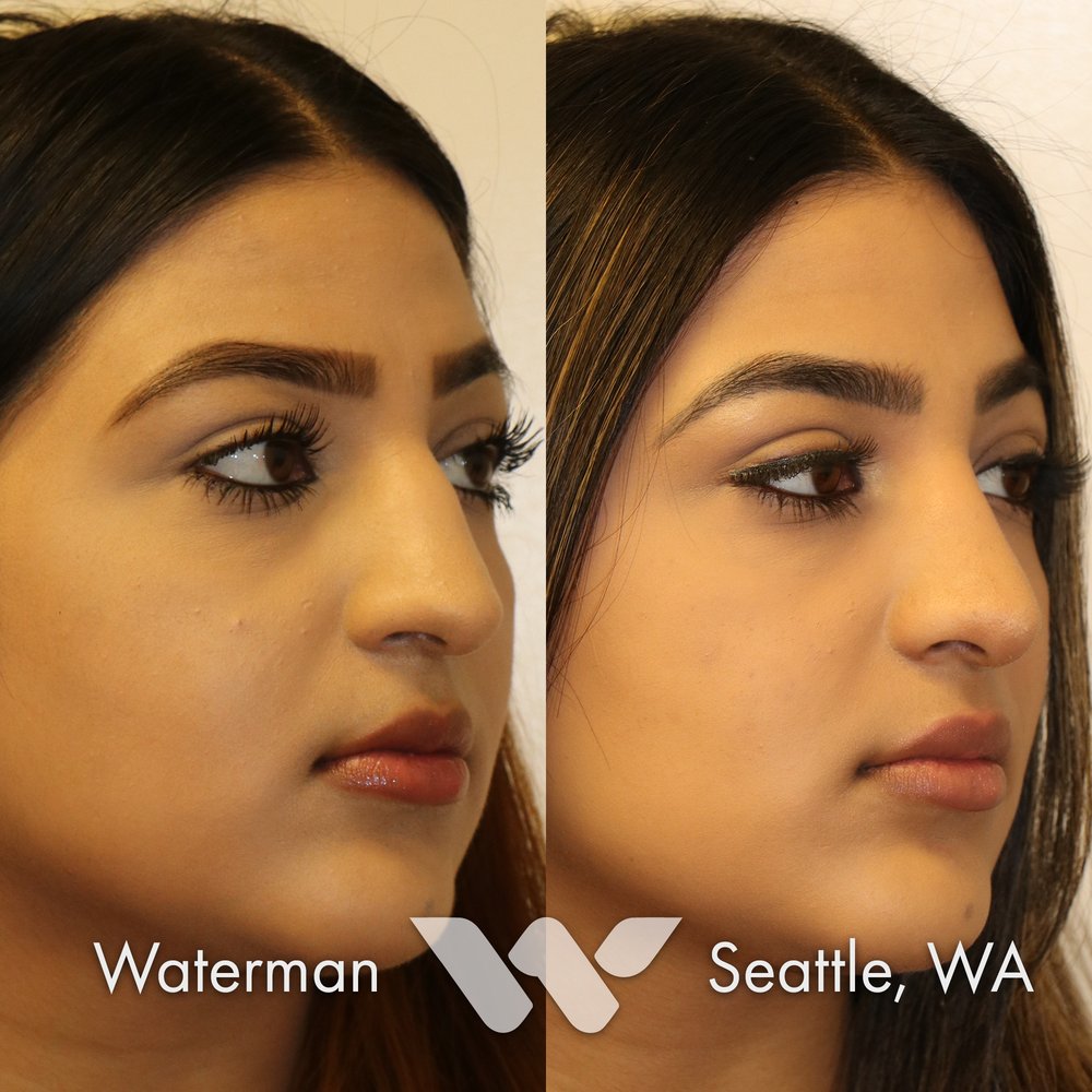 WATERMAN RHINOPLASTY 21 Photos 12402 SE 38th St, Bellevue