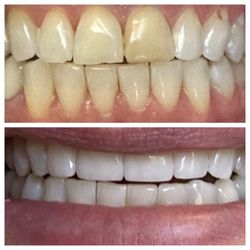 John H Kim, DDS - Before and after the magical master work of Dr Kim.
