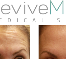 ReviveMD - 10 Units Botox Cosmetic - Applied to the Forehead. Client desired very little movement.