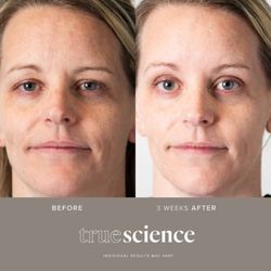 Before and after three weeks.