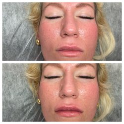 Distinctive Lashes & Beauty - 1ml of HA fillers
