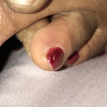 Accent Nails & Spa - Infected hangnails after pedicure. - Nail Salons Near Me - Baton Rouge, Louisiana Accent Nails & Spa - Infected hangnails after pedicure. - Nail Salons Near Me - Baton Rouge, Louisiana