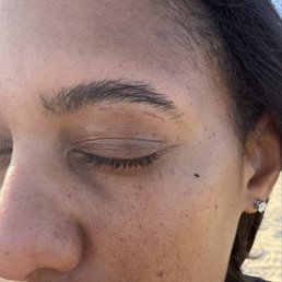 Burns from treatment Burns from treatment