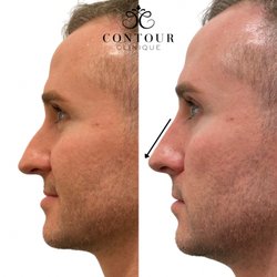 Contour Clinique - Before/After Nose Filler