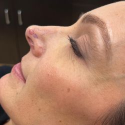 Ali Hendi, MD - Pre-op consultation, Dr. drew out his plan for reconstruction surgery (bi-loped flap)