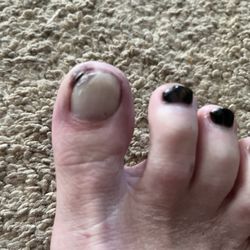 B & E Nails - Infected toe