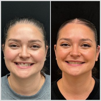 Orange Premier Dental - Invislign before and after - Cosmetic Dentists Near Me - Orange, California Orange Premier Dental - Invislign before and after - Cosmetic Dentists Near Me - Orange, California