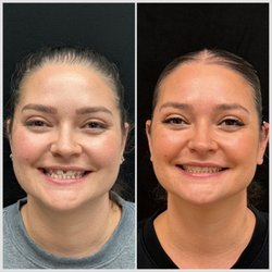 Invislign before and after