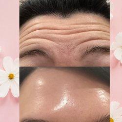 WOW Health & Beauty Medical Spa - Patient had 100 units of Dysport and the results are pretty amazing.