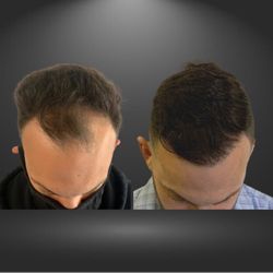 New England Center for Hair Restoration