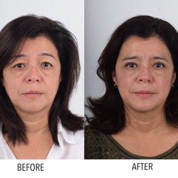 Ptosis and brow lift surgery patient.