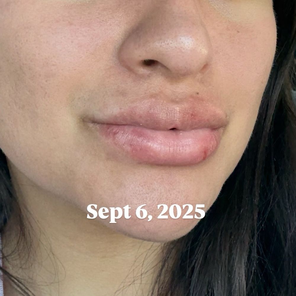 Steven K Struck, MD - Second round of injection since the first didn't work - Cosmetic Surgeons Near Me - Atherton, California Steven K Struck, MD - Second round of injection since the first didn't work - Cosmetic Surgeons Near Me - Atherton, California
