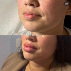 Akeso Aesthetics & Wellness - LIP FILLER