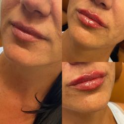 San Diego Skin MedSpa - Lip & Lower face