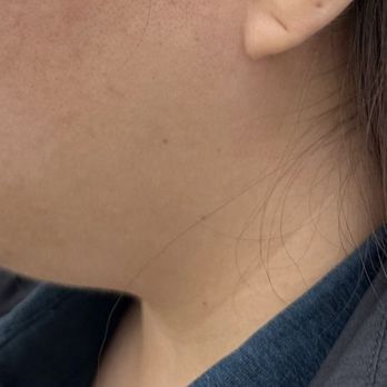 CKE Skincare - Before inmode side - Skin Care Near Me - Los Angeles, California CKE Skincare - Before inmode side - Skin Care Near Me - Los Angeles, California