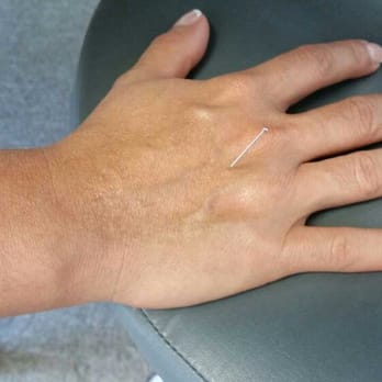 Chengs Acupuncture - Dr cheng said this the hand acupuncture. Work like a magical point - Acupuncture Near Me - brooklyn, New York Chengs Acupuncture - Dr cheng said this the hand acupuncture. Work like a magical point - Acupuncture Near Me - brooklyn, New York