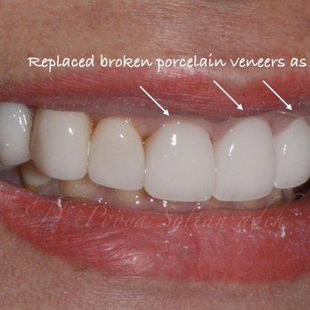 Orange County Prosthodontics - Patient had existing broken veneers. Rather than changing them all, only broken ones replaced. - Cosmetic Dentists Near Me - Anaheim, California Orange County Prosthodontics - Patient had existing broken veneers. Rather than changing them all, only broken ones replaced. - Cosmetic Dentists Near Me - Anaheim, California