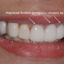 Orange County Prosthodontics - Patient had existing broken veneers. Rather than changing them all, only broken ones replaced.