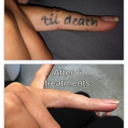 Removery Tattoo Removal & Fading